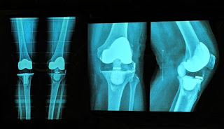 Knee replacement Surgery  in India Knee replacement Surgery  in India
