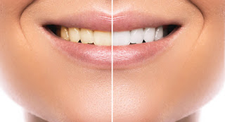 Teeth whitening at home Top tips for Teeth whitening at home