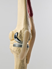 Knee replacement Surgery  in India Knee replacement Surgery  in India