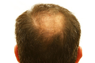 Symptoms of Hair Loss Causes-Symptoms-Types-Hair-Loss