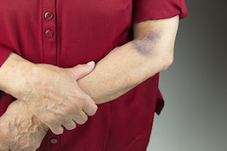 Ways to treat hematoma at home Ways to treat hematoma at home