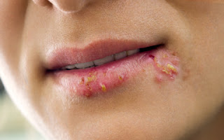 What-you-need-to-know-about-herpes What-you-need-to-know-about-herpes