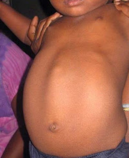 Epigastric Hernia: Causes, Symptoms, and Treatment Epigastric Hernia: Causes, Symptoms, and Treatment