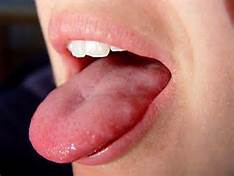 oral thrush Effective Natural Treatments for Oral Thrush