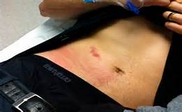 Internal Bleeding Natural Remedies to Heal Internal Bleeding