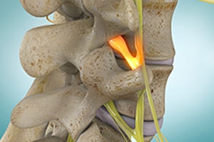 vid-spinal-stenosis.jpg__300.0x200.0_q100_crop_subsampling-2_upscale.jpg